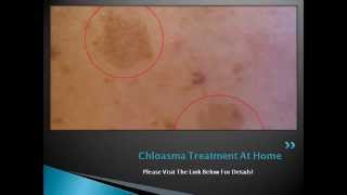 Chloasma Treatment At Home  How to Get Rid of Chloasma or Melasma Naturally [upl. by Baxie]