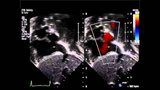 Secundum Atrial Septal Defect Subcostal Saggital View Color Compare [upl. by Annaor]