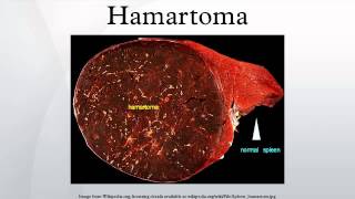 Hamartoma [upl. by Veta]