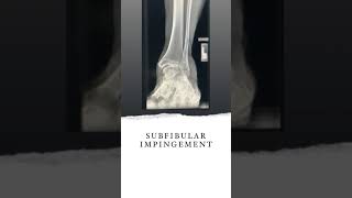 Ankle Replacement  Valgus Ankle Athritis [upl. by Irra]