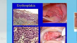 Omneya Wahba Premalignant Lesions 2 [upl. by Selec]