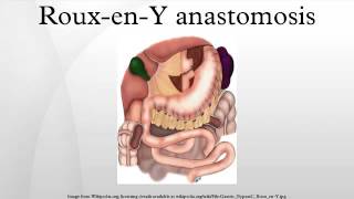 RouxenY anastomosis [upl. by Penman]