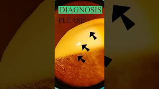 Diabetic retinopathy  Vitreous  Hard exudates  Fundus  Short Video 193 [upl. by Basia630]