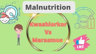 Kwashiorkor vs Marasmus DefinationDifference Malnutrition Nursing notes [upl. by Anastasia352]