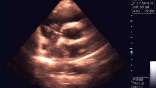 Echocardiography of Hydatide cyst in the interatrial septum [upl. by Gean]