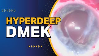 Hyperdeep DMEK [upl. by Zoubek146]