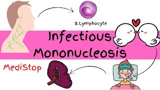 Infectious Mononucleosis  SINGS amp SYMPTOMS PATHOPHYSIOLOGY DIAGNOSIS amp TREATMENT [upl. by Clarey]