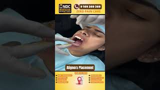 Step By Step Aligners Placement  Best Dental Hospital In Hyderabad  NDC [upl. by Sherill]