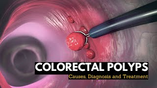 Colorectal Polyps Causes Signs and Symptoms Diagnosis and Treatment [upl. by Maxma]