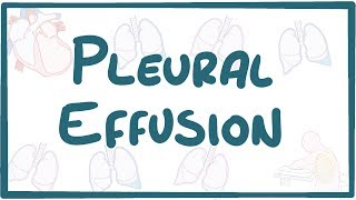 Pleural Effusion  causes symptoms diagnosis treatment pathology [upl. by Georgina]