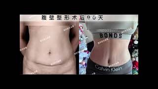 90 days after abdominal plastic surgery [upl. by Flodnar]