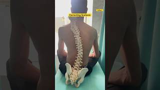 Correcting Scoliosis scoliosistreatment scoliosisawareness spine chiropractic physiotherapy [upl. by Aribold]