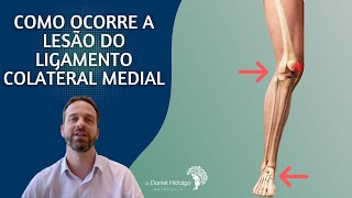 Como ocorre a lesão do ligamento colateral medial [upl. by Whall]