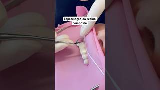 Resina composta 💛 dentista dentistas odontologia dentes faceta facetadental odonto [upl. by Wertz]