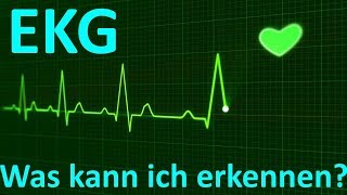 Was erkennt man beim EKG Monitoring 3Kanal [upl. by Ardnayek737]