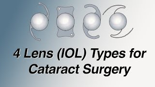 4 Main Lens IOL Types for Cataract Surgery Pros and Cons Basic Version [upl. by Llet]