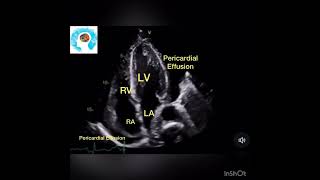 Pericardial Effusion on Cardiac Ultrasound POCUS [upl. by Servais]