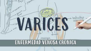 VARICES  Flebitis varices  ENFERMEDAD VENOSA CRONICA [upl. by Yrojram274]