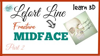 LEFORT LINE 123  FRACTURE MIDFACE [upl. by Notyal]