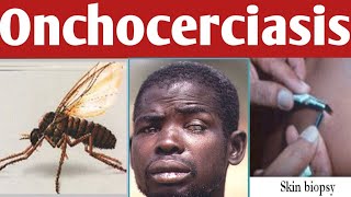 How to Treat River Blindness Onchocerciasis [upl. by Mayman]