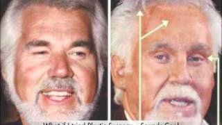 Kenny Rogers Plastic Surgery [upl. by Holli]