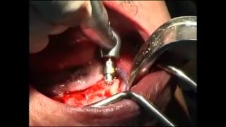 Dental implants  All on 4  immediate loading mandible  Beirut  lebanon [upl. by Roswald]