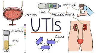 Understanding Urinary Tract Infections [upl. by Eikram433]