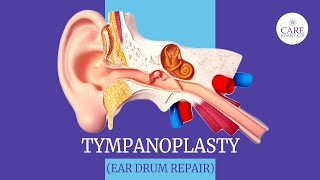 Eardrum Hole Repair Tympanoplasty  How it is done  After Tympanoplasty Care  CARE Hospitals [upl. by Aihsi]