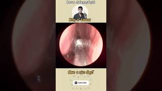 귀지형 콧물 부비동염 축농증 비염 코청소 이비인후과 rhinorrhea rhinitis sinusitis asmr ENT entdoctor [upl. by Anastassia]