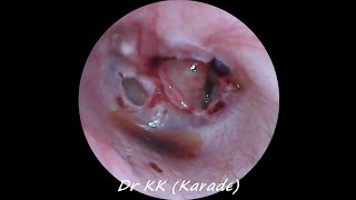 Double Traumatic Tympanic Membrane  Eardrum  Perforation [upl. by Vasya]