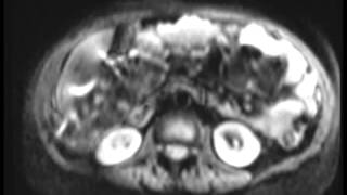 Peritoneal Carcinomatosis [upl. by Catto]