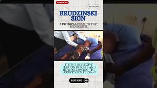 Brudzinski sign [upl. by Loria178]