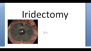 Ophthalmology Iridectomy Indications Procedure Surgical Iridotomy Difference [upl. by Norad]