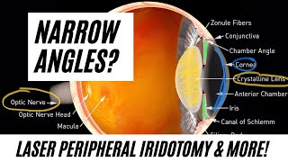 Narrow Angles Does a Laser Peripheral Iridotomy LPI Work [upl. by Katlin926]