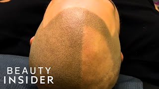 Scalp Tattoos Create The Appearance Of Hair [upl. by Stander379]