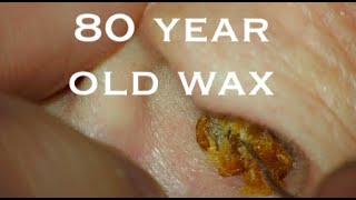 80 yr OLD WAX  I NEVER CLEANED MY EARS  4KHD [upl. by Yhtomit]