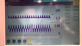 Volumen Garantizado  Alta Frecuencia Ventilatoria Neonatal [upl. by Lupee]