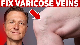 How to Treat Varicose Veins Naturally – Dr Berg [upl. by Eelirrem]