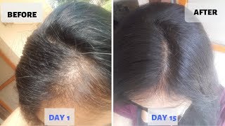 OMG  15 Days Hair Growth Miracle Treatment  Grow Long Thicken Hair  100 works [upl. by Jan898]