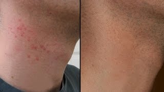 HOW TO CURE RAZOR BURN BUMPS ON NECK amp LEGS [upl. by Harper]