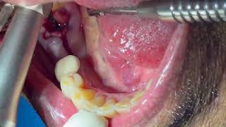 Immediate Post Extraction Placement in the Mandibular Molar Area [upl. by Primalia]