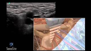 How To Ultrasound Guided Insertion of a Femoral Vein Catheter 3D Video [upl. by Nyvets320]