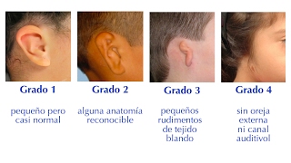 Conocimiento acerca de la Microtia [upl. by Mukerji]