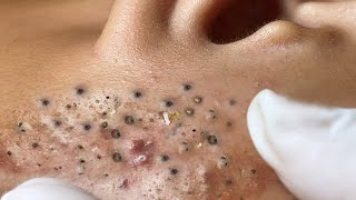 Big Cystic Acne Blackheads Extraction Blackheads amp Milia Whiteheads Removal Pimple Popping  3435 [upl. by Eetnahs]