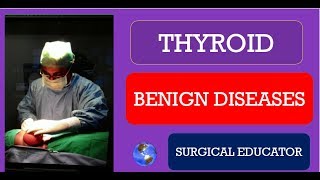 THYROID BENIGN DISEASES How To DIAGNOSE amp TREAT Neck Swellings [upl. by Heurlin]