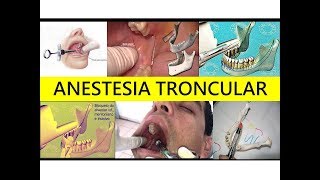 TÉCNICA ANESTÉSICA TRONCULAR INFRAORBITARIA [upl. by Maurilla560]