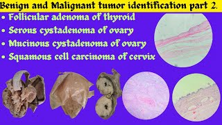 Follicular adenoma of thyroid Serous amp Mucinous Cystadenoma of Ovary SCC of Cervix identification [upl. by Egres]