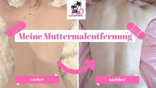 Muttermale lasern I Ich habe es getan I Muttermalentfernung I TALK I September 2016 I Maikikii [upl. by Ezechiel]