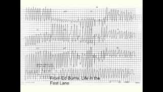 Wolff Parkinson White syndrome WPW [upl. by Yanahc241]