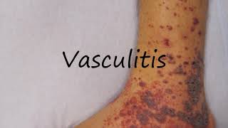 How to Pronounce Vasculitis [upl. by Erminna]